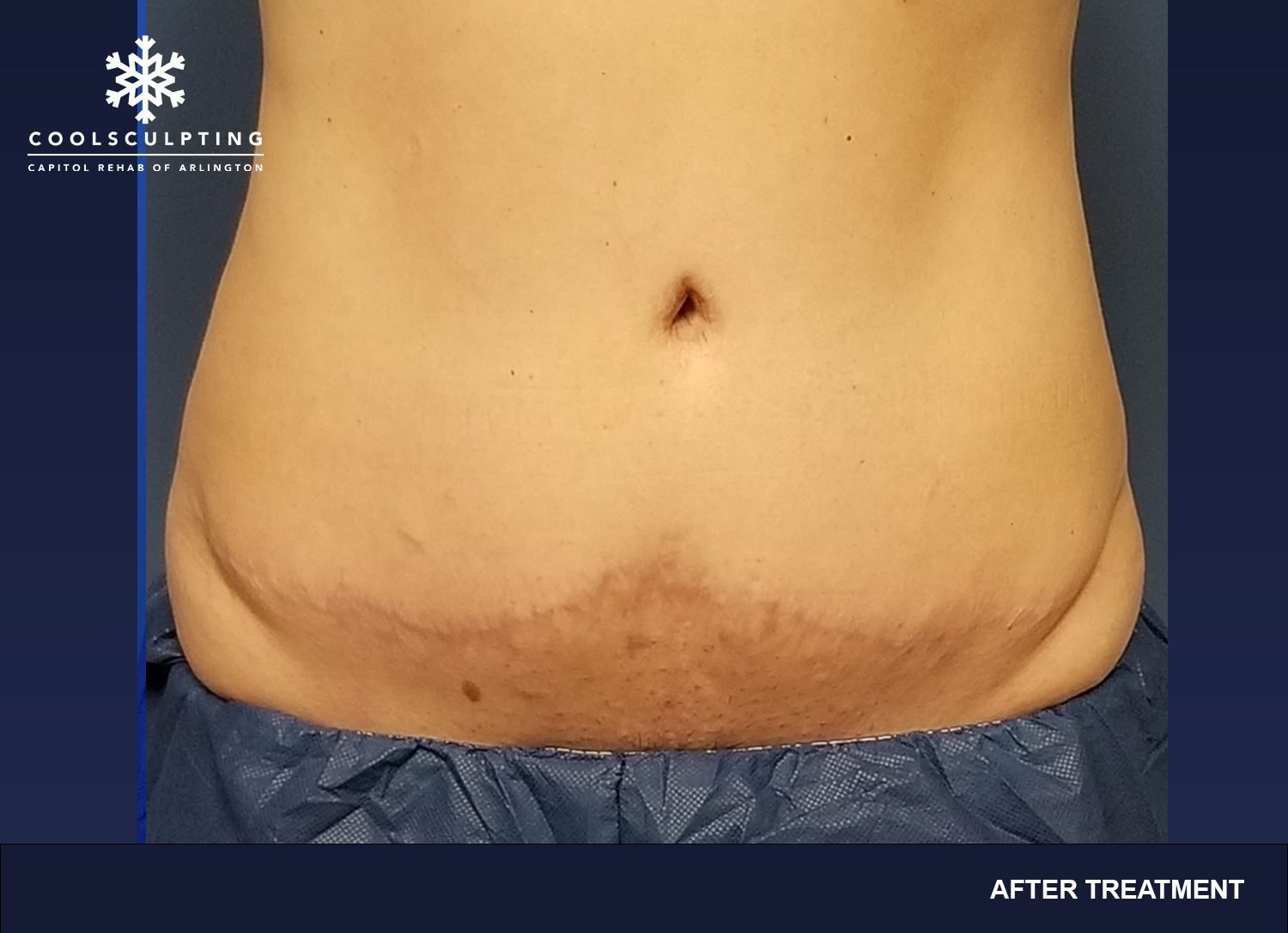 CoolSculpting Patient Transformations - Capitol Rehab of Arlington