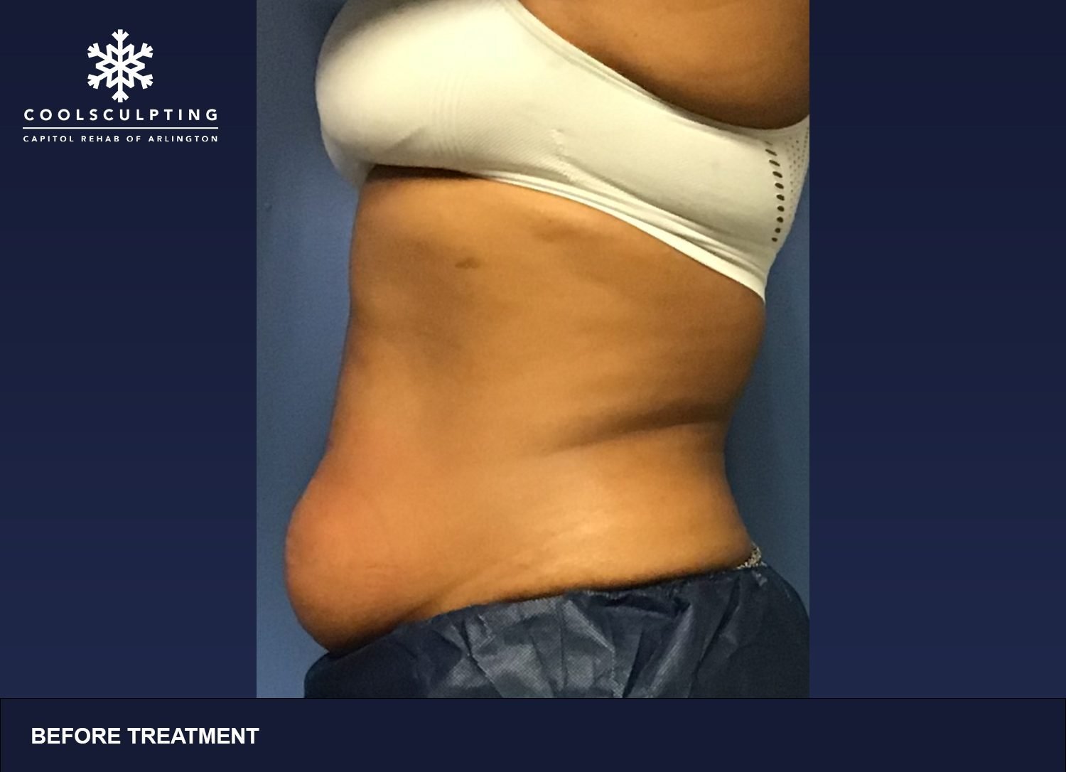 CoolSculpting in Arlington, What You Need to Know