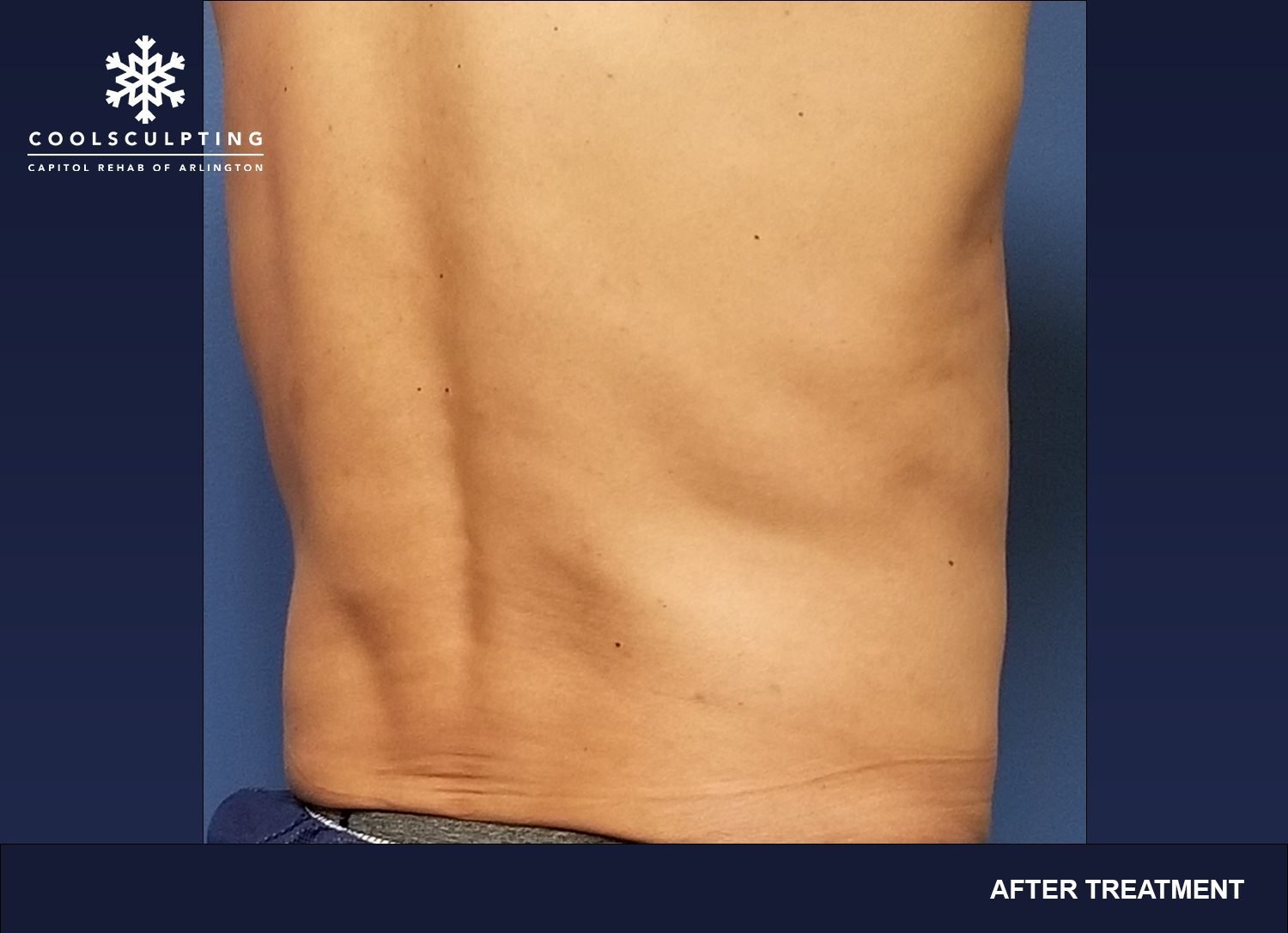 CoolSculpting Patient Transformations - Capitol Rehab of Arlington