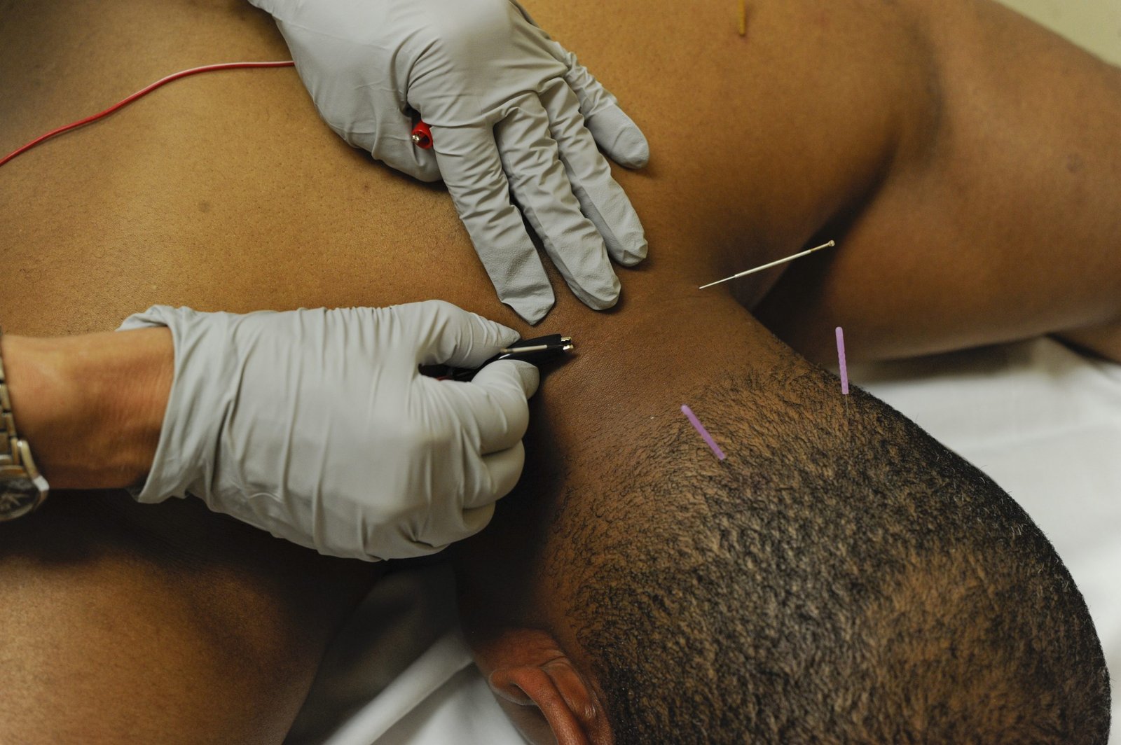 Dry needling uses acupuncture needles, but the technique is based on modern...