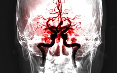 Blood clot in my brain almost ended my life.