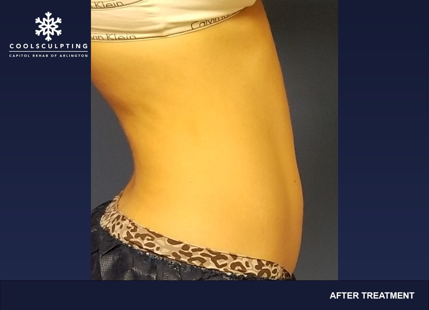 CoolSculpting for Bra Fat, Best CoolSculpting in Arlington