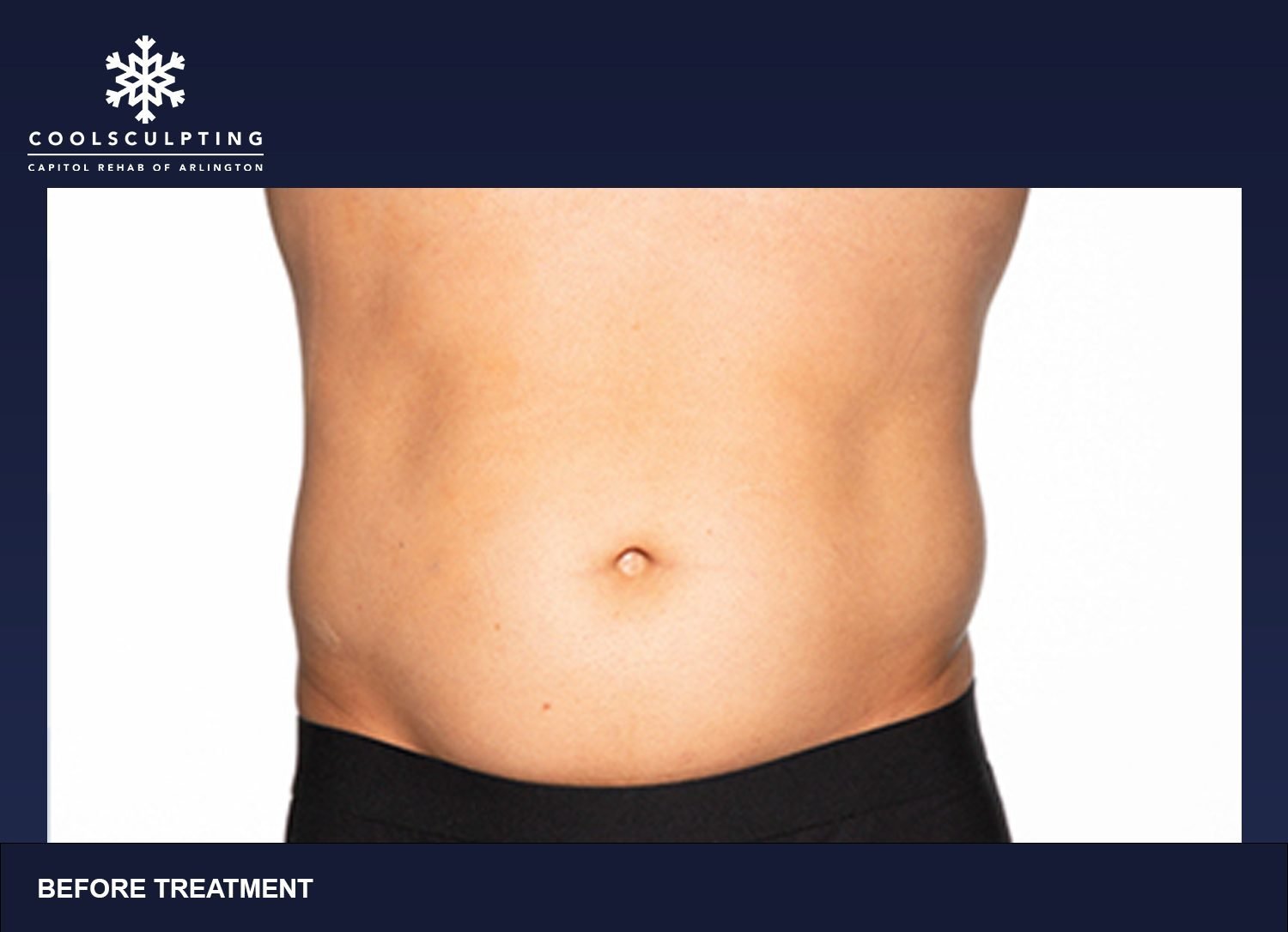 CoolSculpting® in Washington, DC, for Chevy Chase, MD & Arlington, VA
