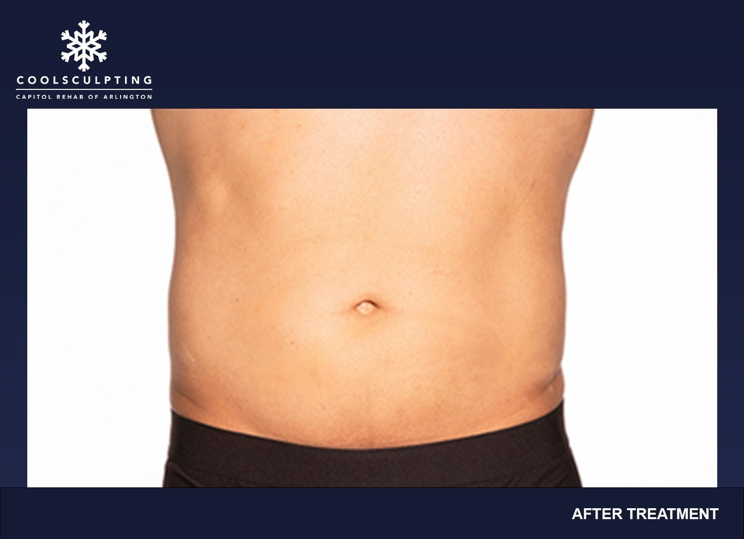 CoolSculpting - Capitol Rehab of Arlington