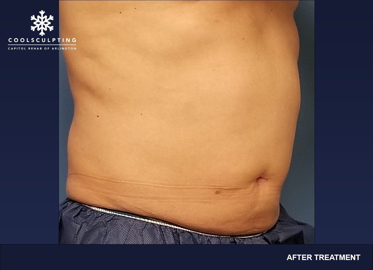 CoolSculpting for Bra Fat, Best CoolSculpting in Arlington