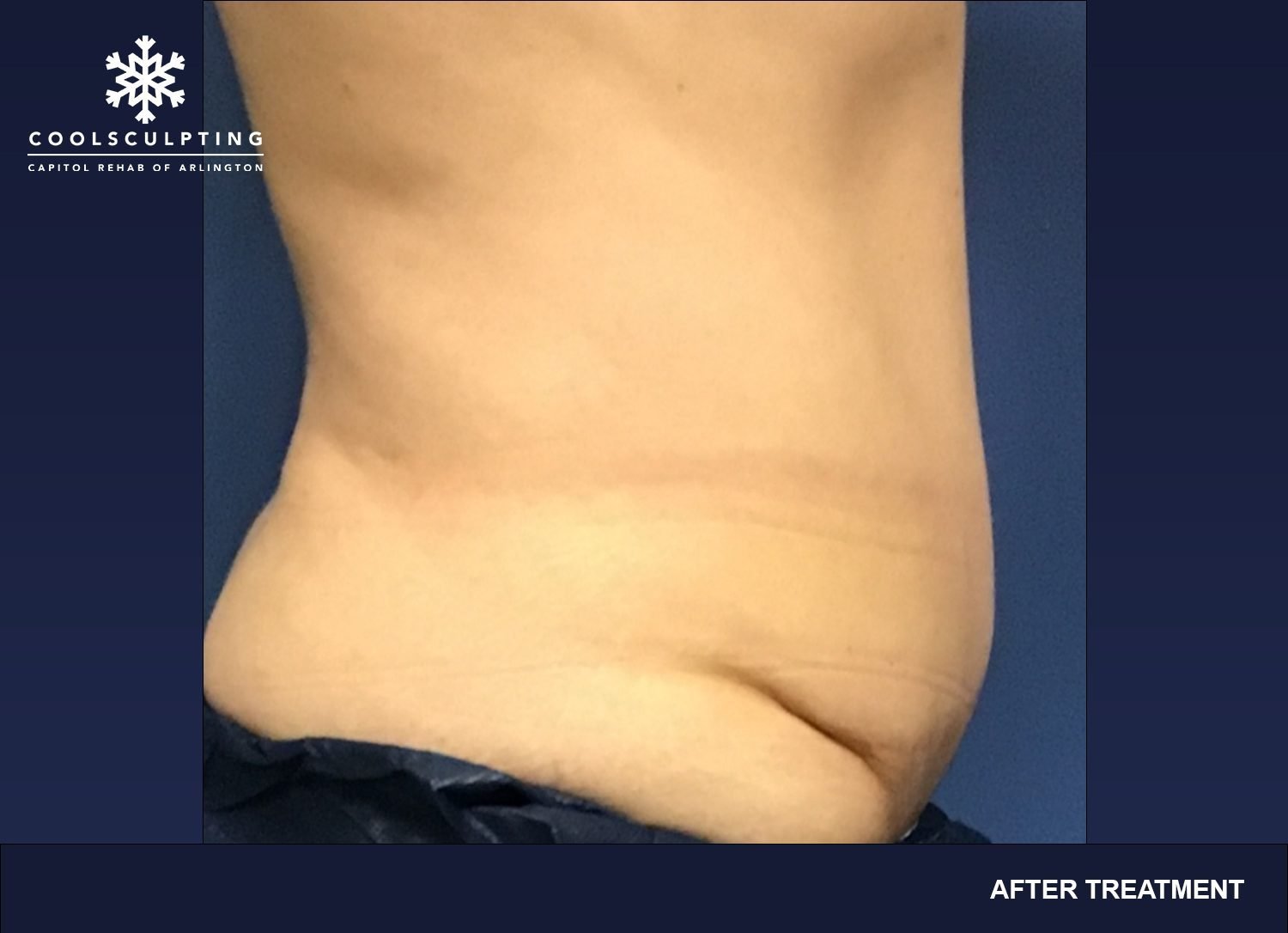 Bra Fat & CoolSculpting®  Arlington & Washington D.C.